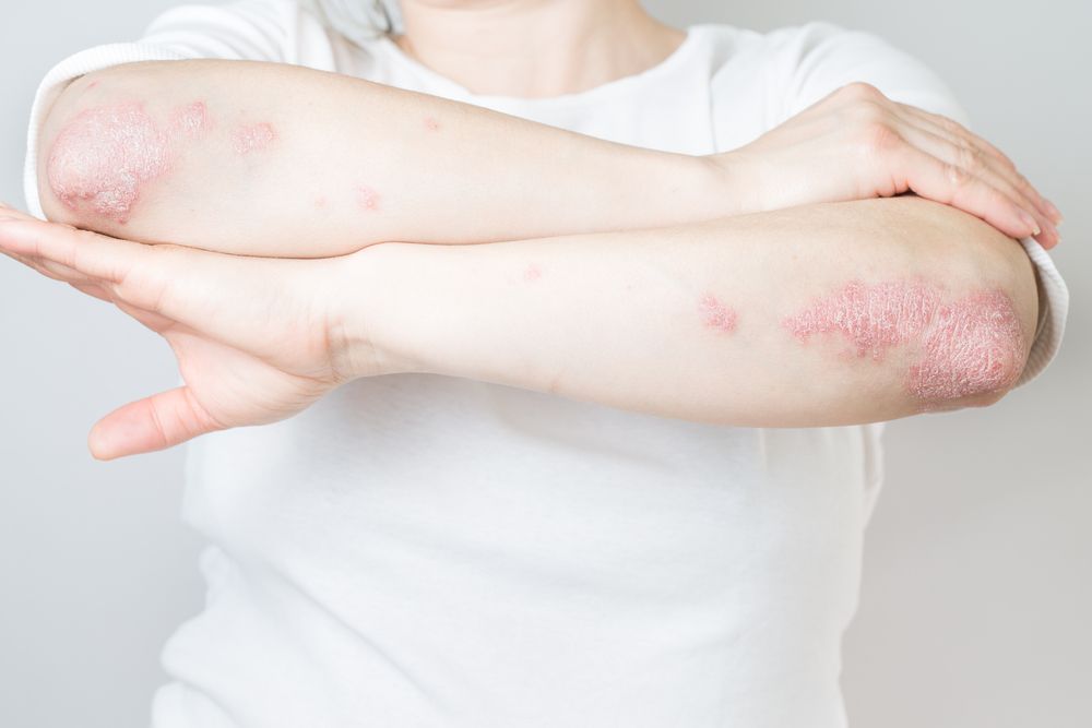 Effective Natural Treatments for Psoriasis