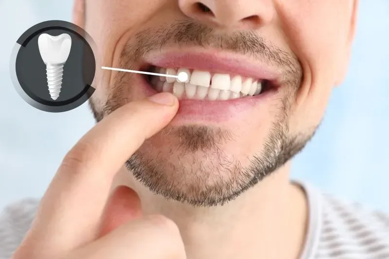 Revitalize Your Smile Instantly: Navigating Same Day Tooth Replacement Services