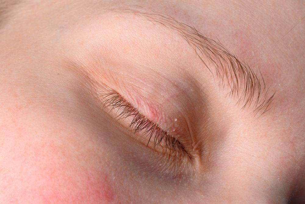 Understanding Eyelash Mites